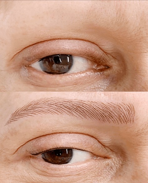 Dermopigmentação de alopecia e sobrancelha