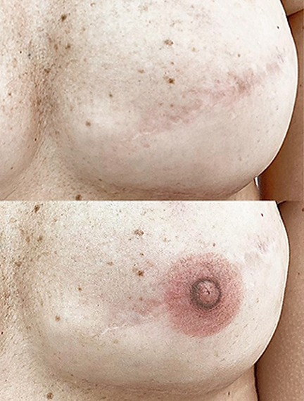 Dermopigmentação de auréola