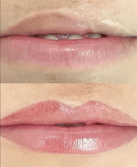 Reconstrução labial
