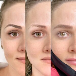 antes e depois de um procedimento estético de sombrancelha, mostra 3 fases do rosto de uma mulher gradativamente com a sombrancelha mais definida