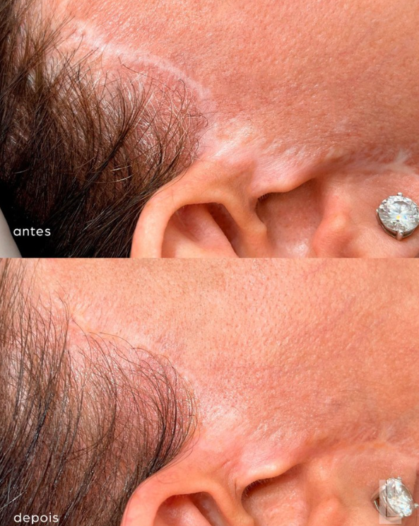 Micropigmentação paramédica para camuflagem de cicatrizes - Lu Make Up